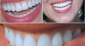 Dişteki Çay Ve Kahve Lekelesi Nasıl Çıkar?